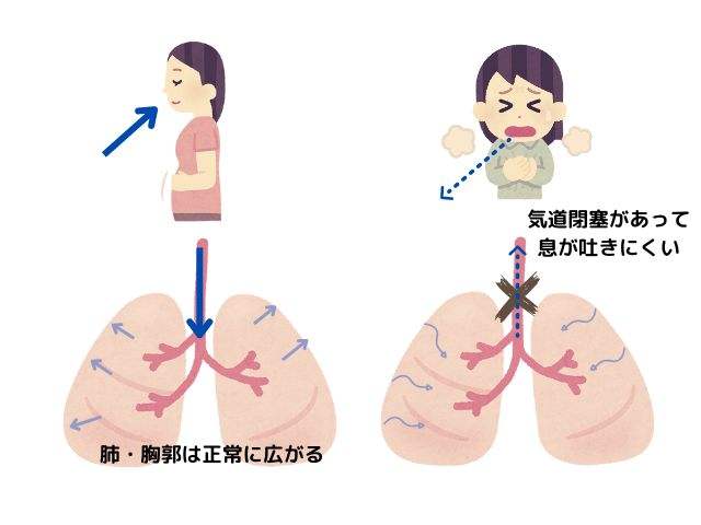 閉塞性換気障害
